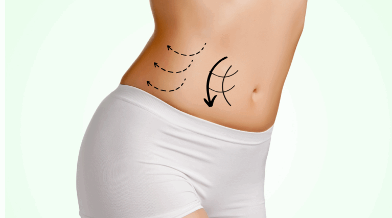 REV-Shape Up (Radio Frequency) Body