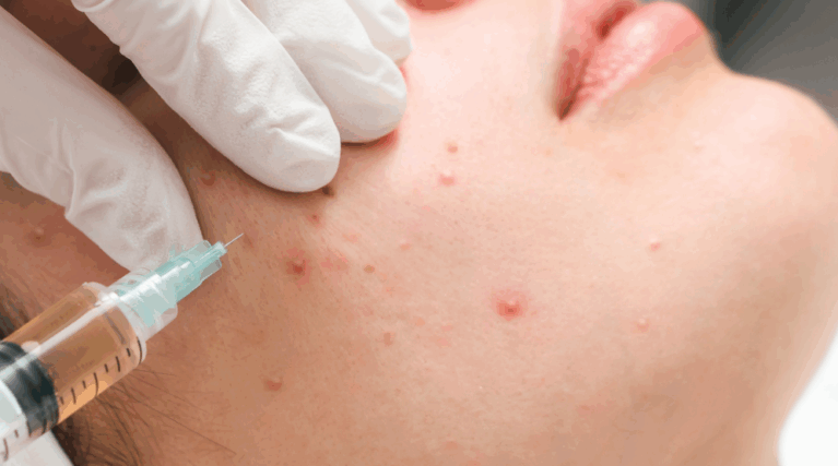 Impurities Extinction